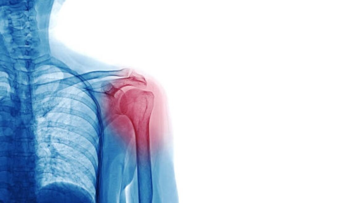Providing Natural Shoulder Pain Relief After Surgery Medicantology